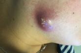 Purple-red nodule on right cheek