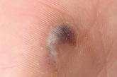 Hyperpigmented lesion on left palm