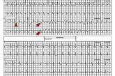 52-year-old man • syncopal episode • chest pain • mild lightheadedness • Dx?