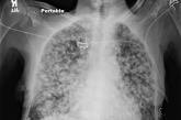 Soft-tissue densities in bilateral lungs on x-ray