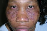 Discoid lupus