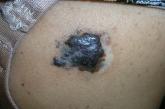 Melanoma