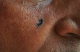 Basal cell carcinoma