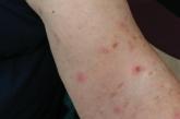 Rash on upper arm