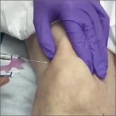 Superolateral knee injection with a patellar tilt for osteoarthritis pain