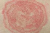A 6-cm erythematosus, scaly plaque on the abdomen