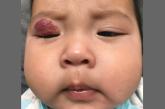 Infant with red eyelid lesion