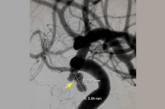 Cerebral angiography showing a posterior communicating artery aneurysm Cerebral angiography showing a posterior communicating artery aneurysm