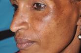 Melasma on the face of an African woman, with hyperpigmentation on the upper cheeks and lateral to the eyes.