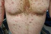Severe rash after COVID-19 vaccination