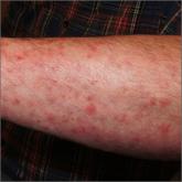 Itchy pustules over hair follicles