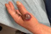 Ulcerated nodule with accompanying swelling