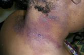 A Black woman with ACD on the neck