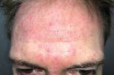 Erythematous papules and pustules on the face Erythematous papules and pustules on the face