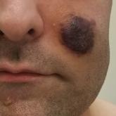 Indurated violaceous lesions on the face