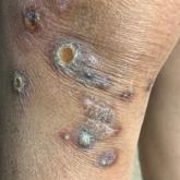 Excoriated papules and plaques on the legs