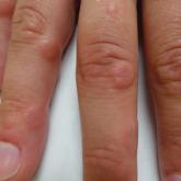 Multiple discrete, erythematous, indurated papules on the dorsal and lateral sides of the fingers. 