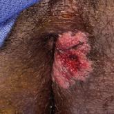 Erythematous Plaque on the Groin and Buttocks