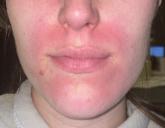 Wet Your Whistles: Alcohol-Induced Flushing With Use of Topical Calcineurin Inhibitors