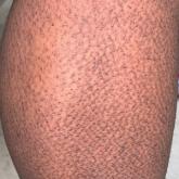 Rippled macules and papules on the leg