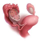 Treating polycystic ovary syndrome: Start using dual medical therapy