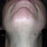A patient with erythematous macules and papules involving the neck and face was diagnosed with lupus erythematosus tumidus