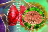 Rise of the fungi: Pandemic tied to increasing fungal infections