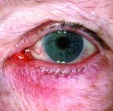 Microbiome studies among those awarded National Rosacea Society grants