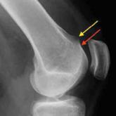 The Effect of Ligament Injuries on Outcomes of Operatively Treated Distal Radius Fractures