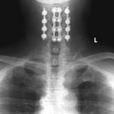 Combined Anterior-Posterior Decompression and Fusion for Cervical Spondylotic Myelopathy
