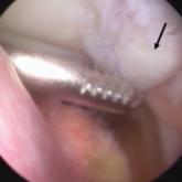 Correct Positioning of the Medial Patellofemoral Ligament: Troubleshooting in the Operating Room