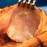 Joint-Preserving Osteotomies for Isolated Patellofemoral Osteoarthritis: Alternatives to Arthroplasty