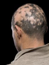 Current alopecia areata options include old and new therapies