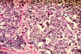 USPSTF recommends preventive breast cancer medications only for women at risk