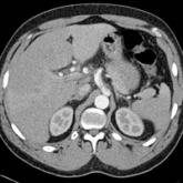 Dissection of the Celiac Artery