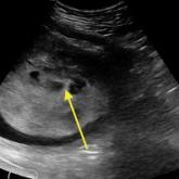 Diagnosis at a Glance: Partial Hydatidiform Molar Pregnancy