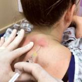 Paraspinous Cervical Nerve Block for Primary Headache