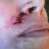 Treatment Protocol for Acute Arterial Occlusion Secondary to Facial Revolumization Procedures