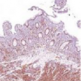 Lenalidomide plus rituximab achieves 87% response rate