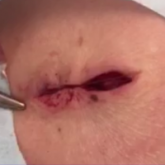 Pulley Suture for Wound Closure