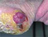The Case of the Nonhealing Wound