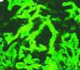 A Case of Kidney Failure