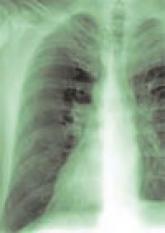 A Case of Emphysematous Cystitis