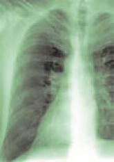 Fibromuscular Dysplasia