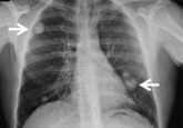 A farmer with chest pain and lung nodules