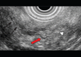 Endoscopic ultrasonography to evaluate pancreatitis