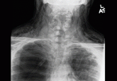 A 47-year-old man with chest and neck pain