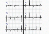 Should we still use electrocardiography to diagnose pericardial disease?