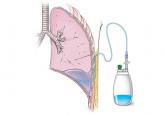 When should an indwelling pleural catheter be considered for malignant pleural effusion?