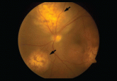 Flashing lights, floaters, and reduced vision